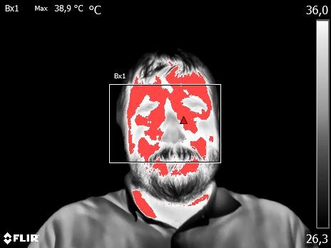 Obr. č. 5: Termogram (snímek z termokamery). Funkcí izoterma jsou na povrchu kůže lokalizována místa, kde je překročena teplota 37.5 °C. Pozn.: demonstrativní účely uvedená osoba se nenacházela v oblasti Wuhanu a není nositelem viru z Wuhanu.